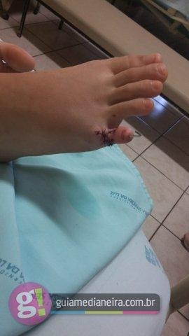 Segundo a mãe da adolescente, ela perdeu os movimentos do dedinho, pois a mordida acabou afetando o tendão do membro.(Foto: Reprodução)