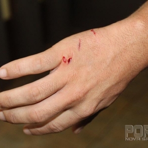 Ferimentos causado pelo agressor na mão do policial. (Foto: Portal Nova Santa Rosa