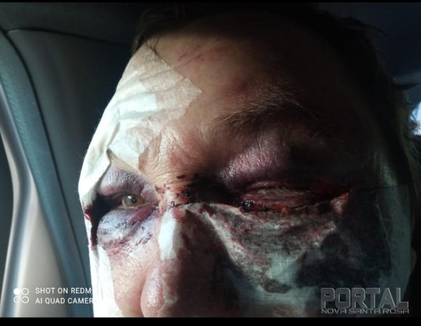 Rosto do idoso após as agressões. Foto: Portal Nova Santa Rosa.