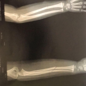 Imagem do Raio X do braço da criança. Foto: Reprodução.