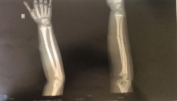 Imagem do Raio X do braço da criança. Foto: Reprodução.