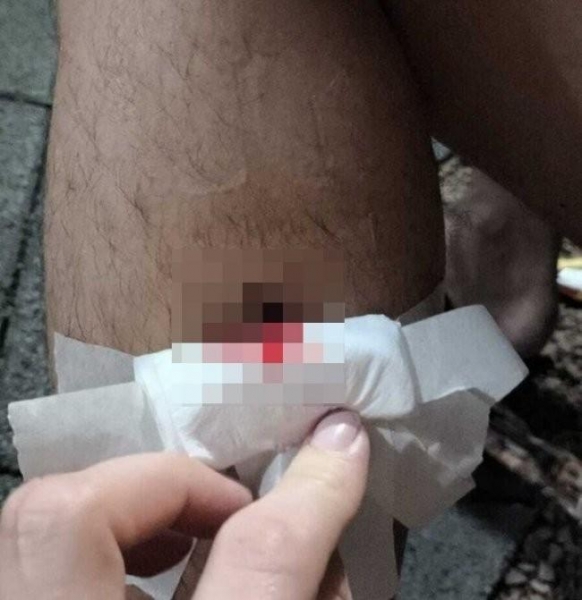 Ferimento com a piranha. Foto: Prefeitura de Santa Helena.